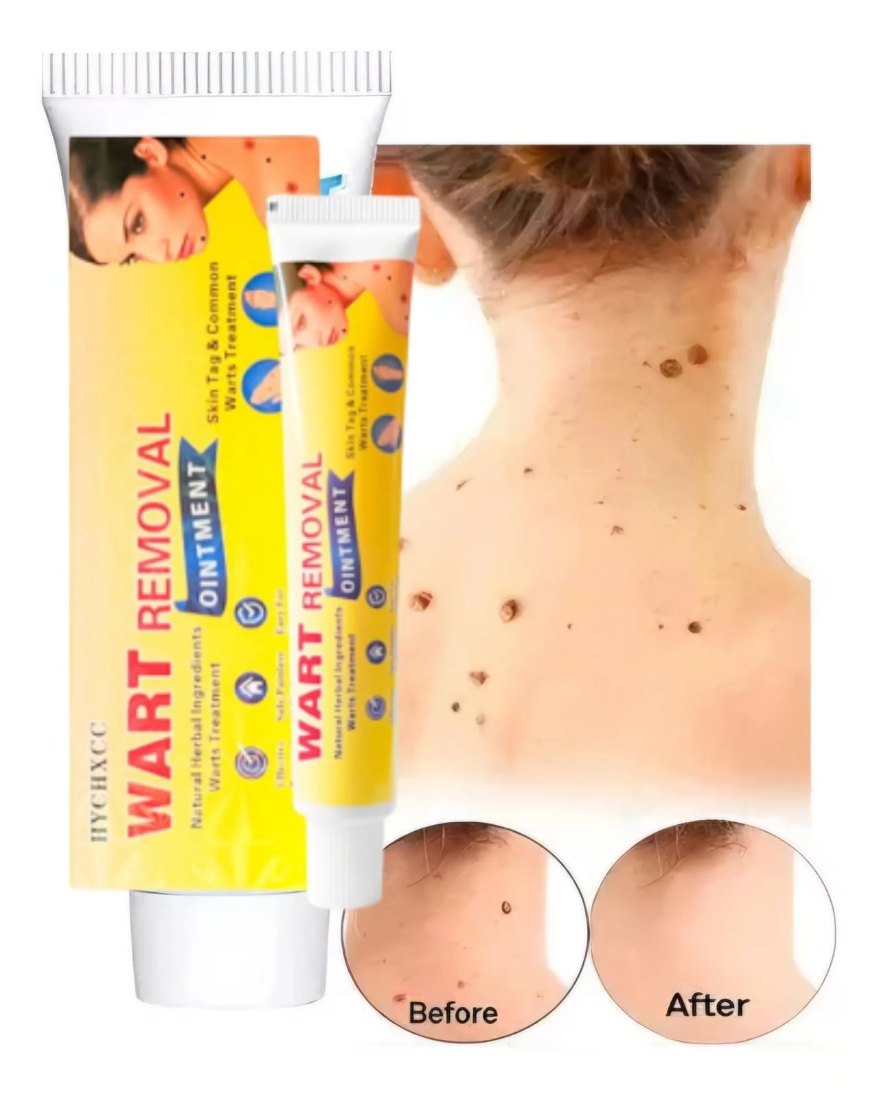 ¡CREMA REMOVEDORA DE VERRUGAS!